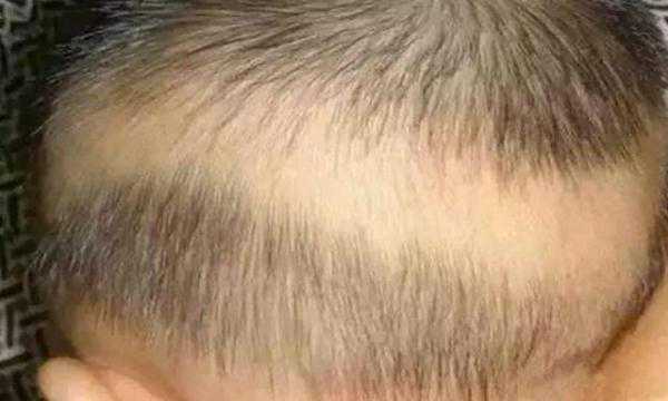 婴儿后脑勺没头发说明有福？不要再迷信了，听听医生怎么说！