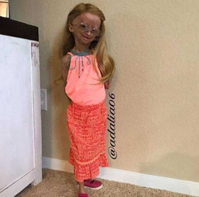 早衰症女孩，头发掉光形如ET外星人，乐观不屈收获150万粉丝